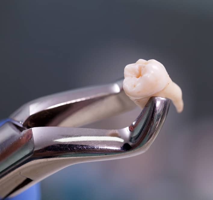 tooth extraction